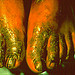 Effects of work shoes from sweating, by National Institute for Occupational Safety and Health. This patient developed a bilateral and symmetric sub-acute dermatitis from the rubber accelerator, mercaptoben zothiazole, which was leached from the rubber portion of his work shoe as a result of sweating. In this case there is some edema and erythema.