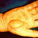 Hand with evidence of an electrical burn, by National Institute for Occupational Safety and Health. Electrical burns may show erythema and bullae from the heat of arcing current or may be non-descript with severe internal damage between the points of contact and exit of the current.